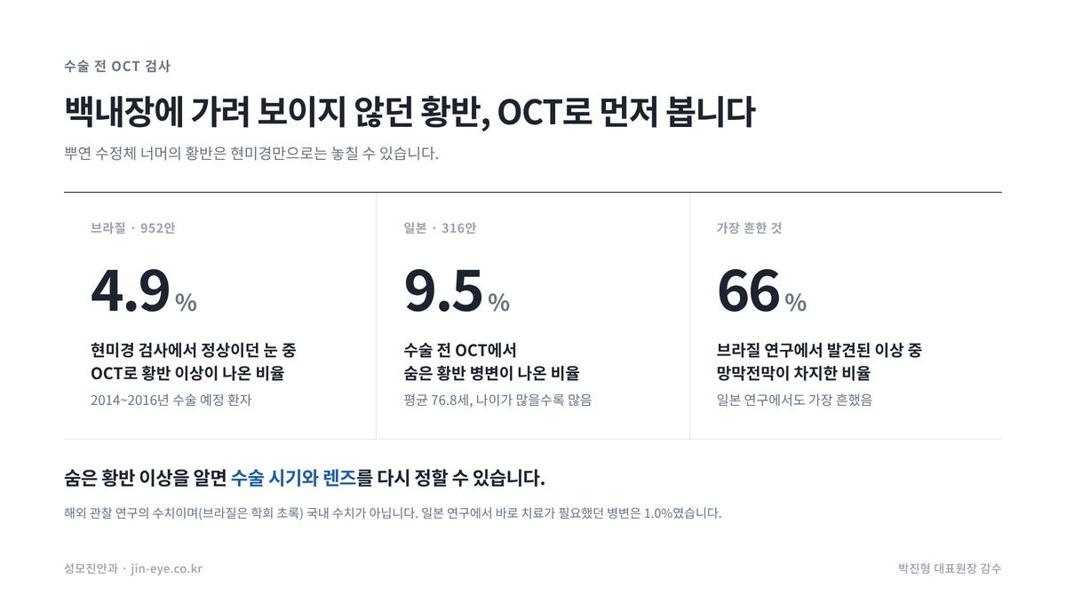 백내장 수술 전 망막 검사 OCT로 발견한 숨은 황반 이상 — 브라질 4.9%, 일본 9.5%, 가장 흔한 것은 망막전막