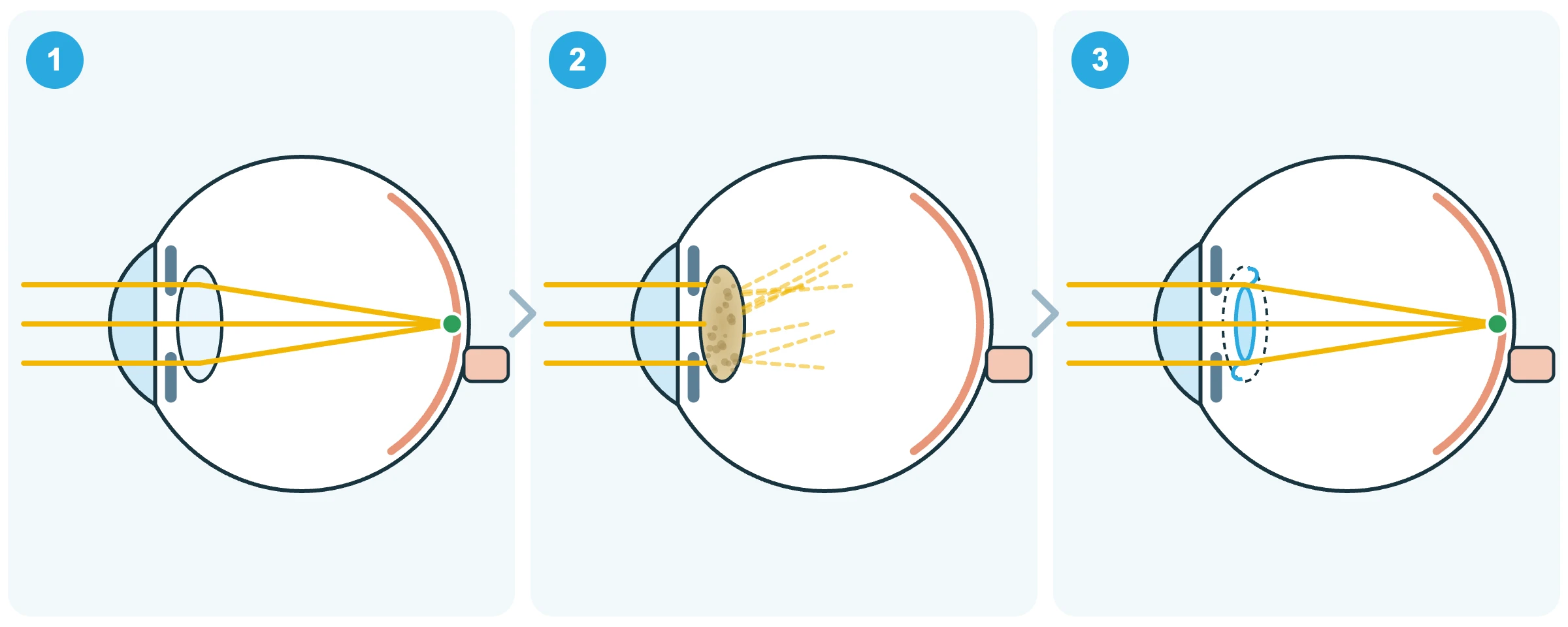 Simplified diagram showing a healthy lens, cataract, and an intraocular lens after cataract surgery
