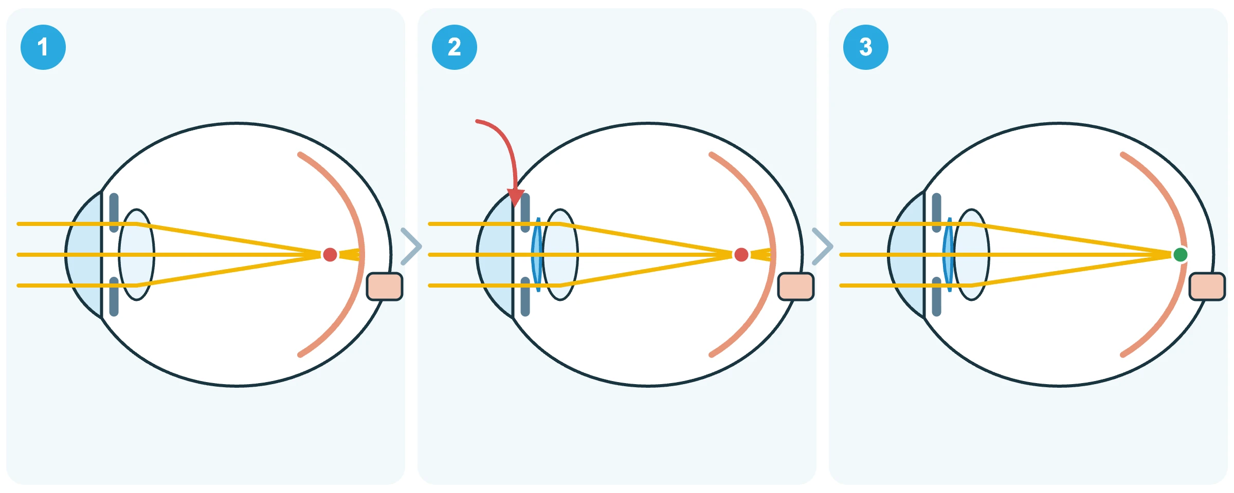 Diagram showing myopic focus and EVO ICL placement behind the iris and in front of the natural lens