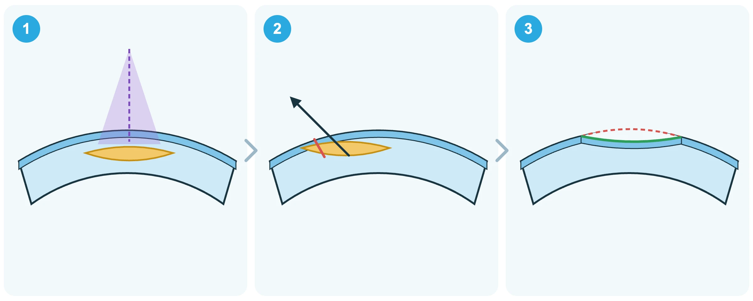 Three-step diagram showing femtosecond laser lenticule creation and removal during SILK vision correction