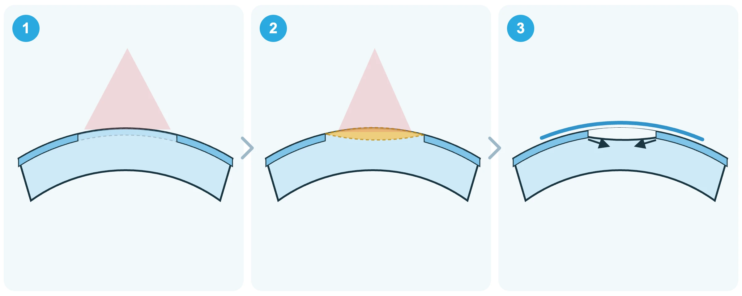 Three-step diagram showing epithelial removal, corneal reshaping, and bandage contact lens placement during TransPRK